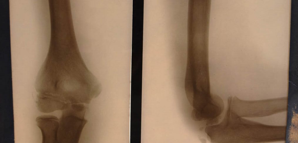 x-ray of elbow straight and bent
