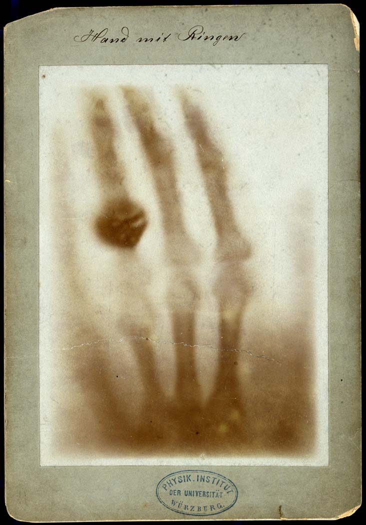 Early X-ray of Röntgen’s wife's hand with ring on third finger