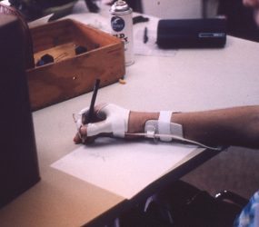 splint device on patients arm, patient holding pencil and drawing a stick figure