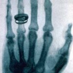 X-ray image of hand