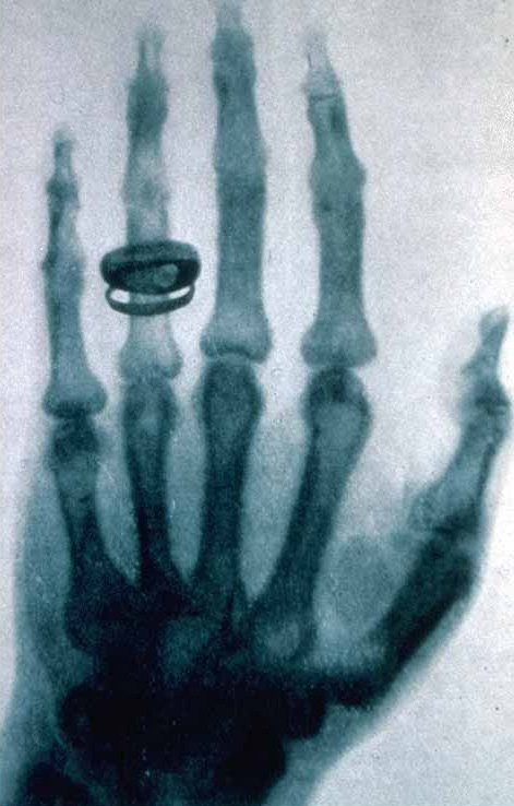 Xay Wilhelm Röntgen – first X-ray of Roentgen’s wife’s hand with ring